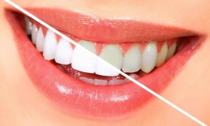 Как отбеливать зубы?